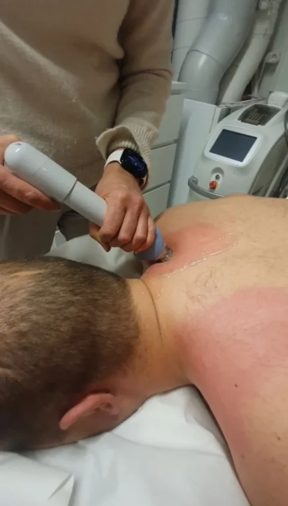 Iskuaaltohoito hartiaseudun kipualueelle fysioterapiassa